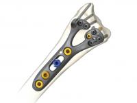 GEMINUS distal radius plate: image from Skeletal Dynamics